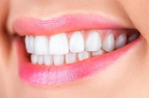 Discover How Long Teeth Whitening Lasts and How to Extend the Results